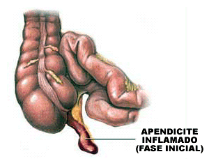apendiciteaguda