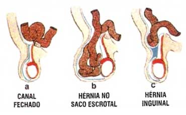 Hernia: What it is, Symptoms, Types, Causes & Treatment